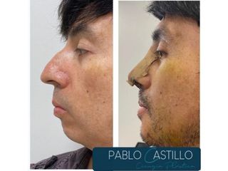 Rinoplastia - Dr. Pablo Castillo