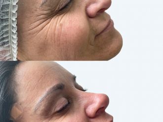 Rejuvenecimiento facial antes y después - 875869