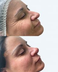 Rejuvenecimiento Facial - Estética Facial Rancagua. Dra Fernanda Silva Tobar