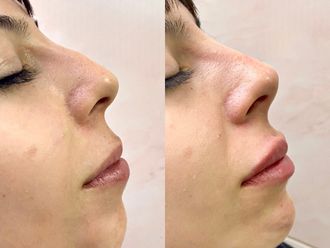 Armonización facial antes y después - 875870