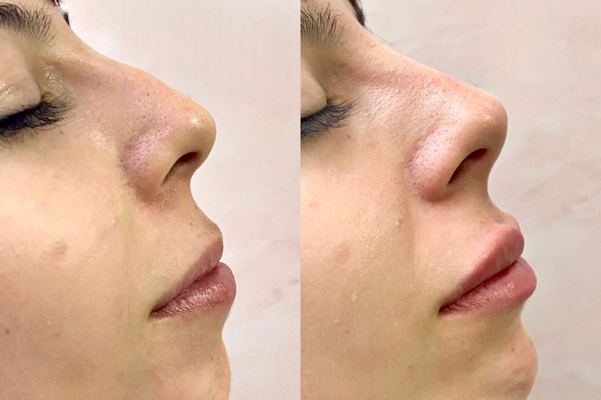 Armonización facial antes y después - 875870