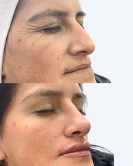 Rejuvenecimiento Facial - Estética Facial Rancagua. Dra Fernanda Silva Tobar