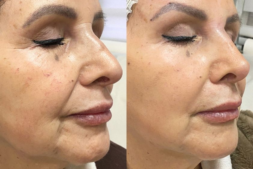 Rejuvenecimiento facial antes y después - 875872