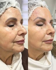 Rejuvenecimiento Facial - Estética Facial Rancagua. Dra Fernanda Silva Tobar