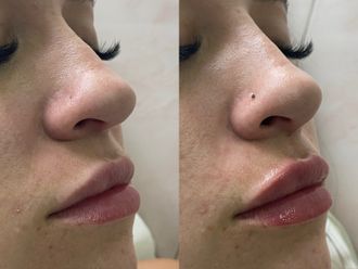 Armonización facial antes y después - 875873