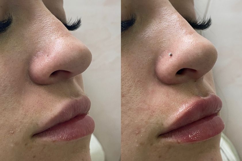 Armonización facial antes y después - 875873