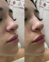 Armonización Facial - Estética Facial Rancagua. Dra Fernanda Silva Tobar