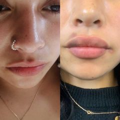 Aumento de labios con Acido Hialurónico - Clínica Odontomar