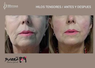 Hilos Tensores - Clinica Odontomar