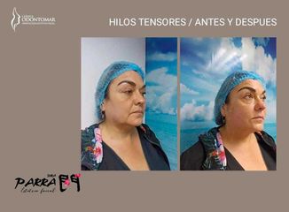 Hilos Tensores - Clinica Odontomar