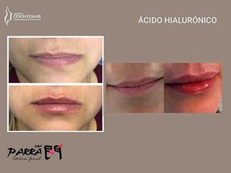 Aumento de labios - 865477