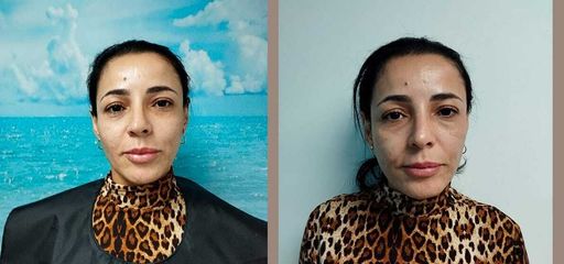 Rejuvenecimiento Facial con Bioestimulador - Clinica Odontomar