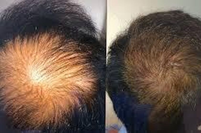 Alopecia antes y después - 865482