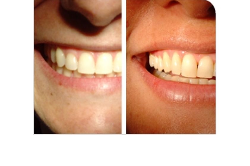 Blanquear dientes antes y después - 316874