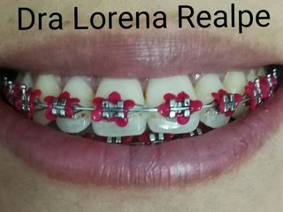 Brackets