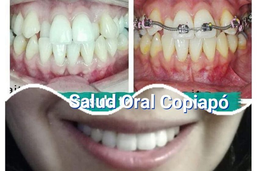 Brackets antes y después - 628236