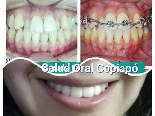 Ortodoncia sin extracion de piezas dentales