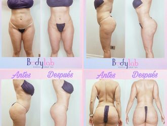 Tratamiento celulitis antes y después - 828476