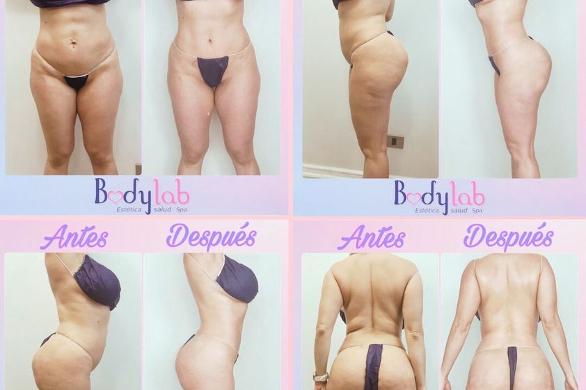 Tratamiento celulitis antes y después - 828476