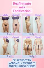 Tratamiento celulitis - Bodylab