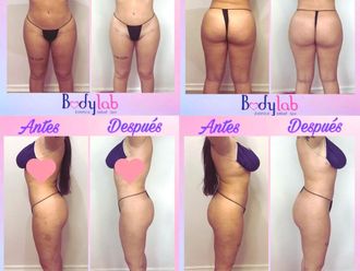 Tratamiento celulitis antes y después - 828477