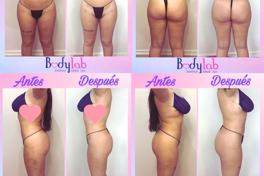 Tratamiento celulitis antes y después - 828477