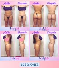 Tratamiento celulitis - Bodylab