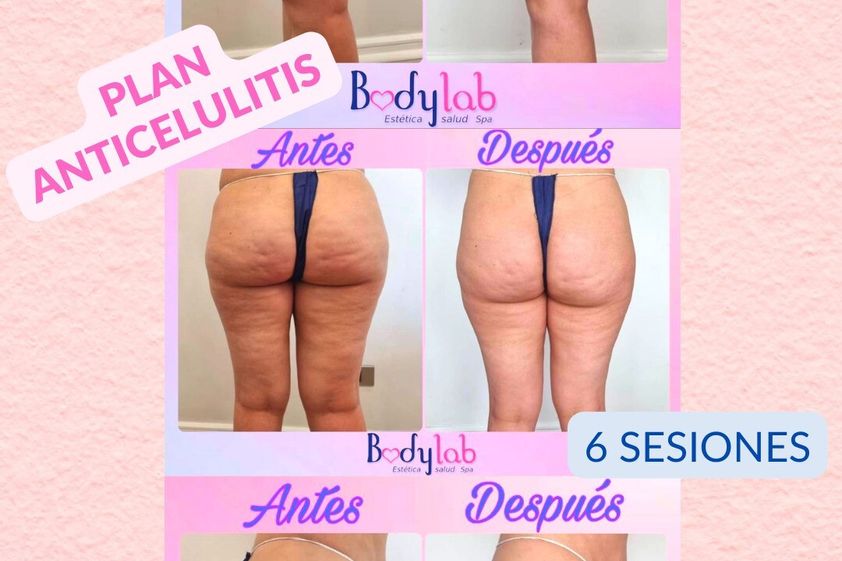 Tratamiento celulitis antes y después - 828478