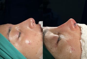 Rinoplastia - Dr. Erick J. Aliaga Santos