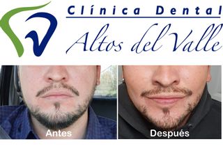 Bichectomía - Clínica Dental Altos del Valle