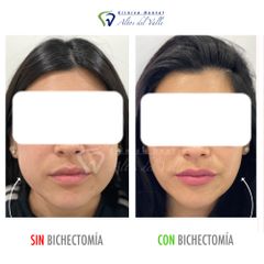 Bichectomía - Clínica Dental Altos del Valle