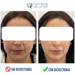 Bichectomía - Clínica Dental Altos del Valle
