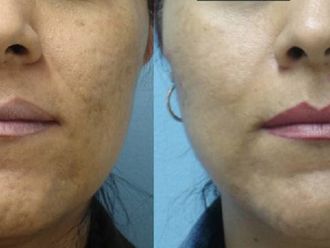 Microdermoabrasión Antes y después - Clinicasesteticas.cl