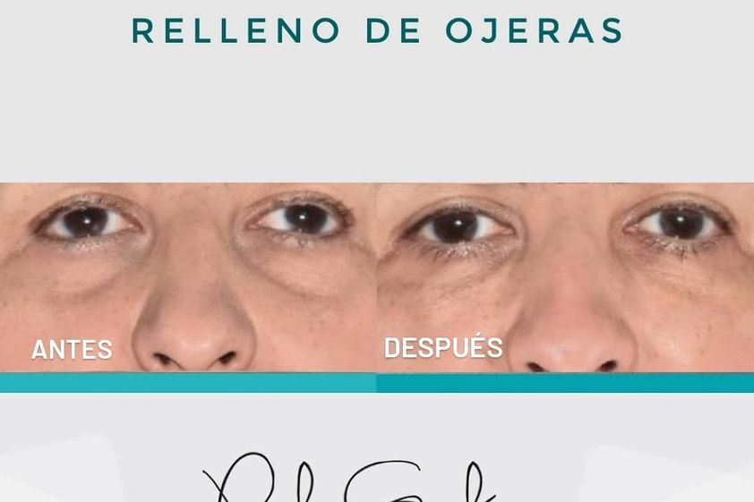 Tratamiento de bolsas en los ojos antes y después - 738927