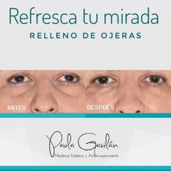 Tratamiento de bolsas en los ojos - Dra. Paula Gavilán