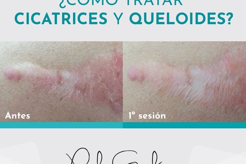 Borrar cicatrices antes y después - 738931