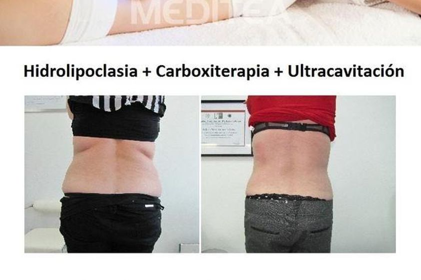 Carboxiterapia antes y después - 530433