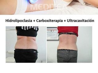 Resultados de Hidroplipoclasia
