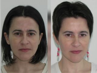 Rejuvenecimiento facial