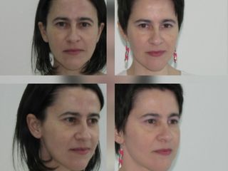 Rejuvenecimiento facial