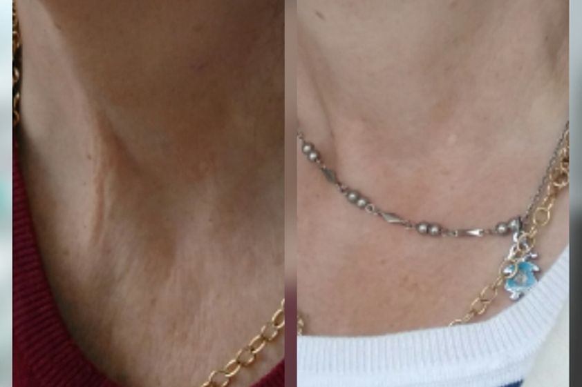 Cavitación antes y después - 568180