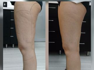 Antes y despues de tratamiento de celulitis