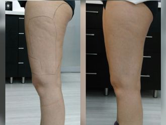 Tratamiento celulitis - 629339