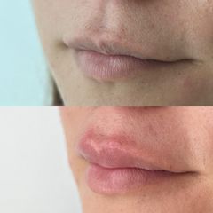 Aumento de labios - Dra. Cecilia Parrao