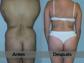 Lipoescultura  