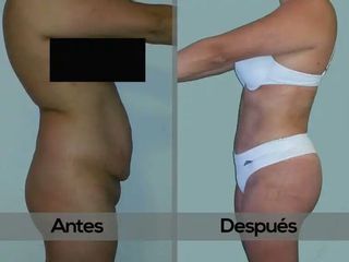 LipoAbdominoplastia