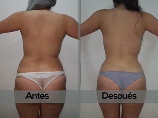 LIPO