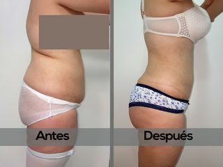 Abdominoplastia, Lipoescultura con Lipoproyección Glútea