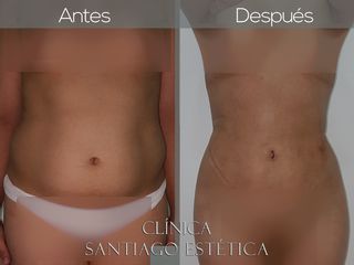 LIPOESCULTURA 