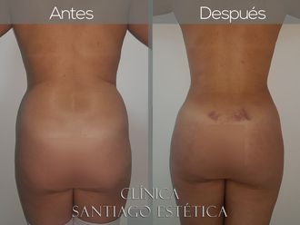 Liposucción - 627087